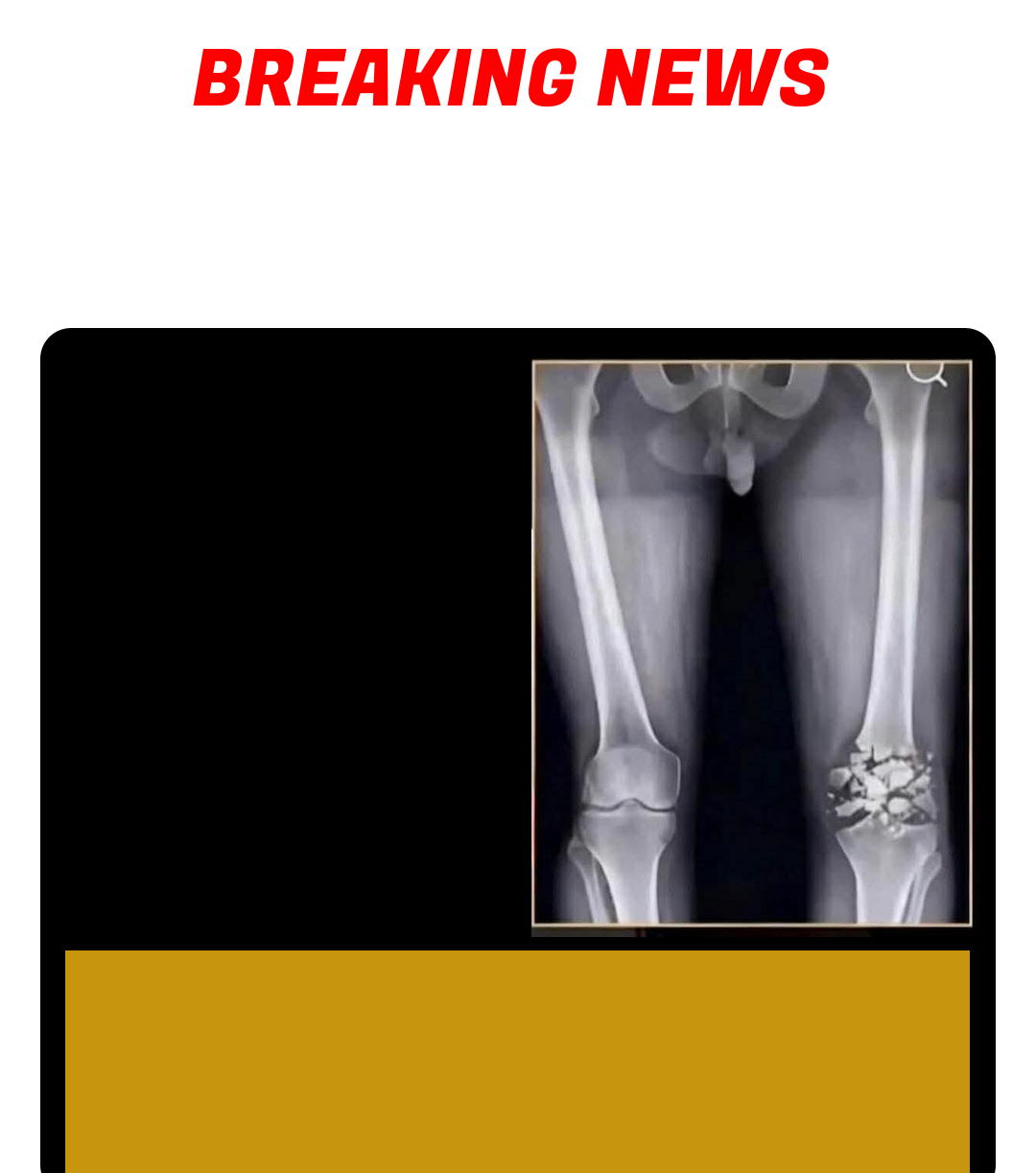Knee X-Ray Breaking News meme template - Create a fake breaking news knee injury report meme. Enter any name and upload a photo to make a personalized injury announce